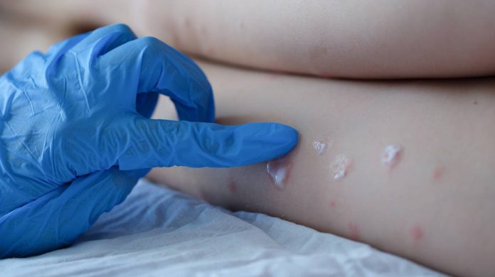 Vaiolo delle scimmie